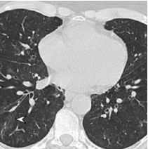 Chest computer tomography (CT) with bilateral nodules and masses