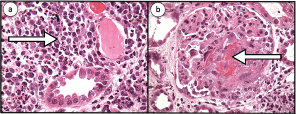 Pathology results from a real kidney biopsy with AAV