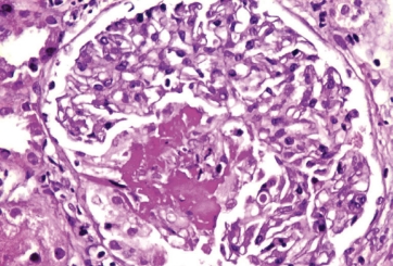 Kidney biopsy showing necrotizing pauci-immune glomerulonephritis