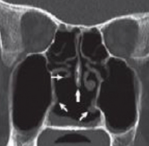 Sinonasal disease with coronal CT showing damage in nasal cavity