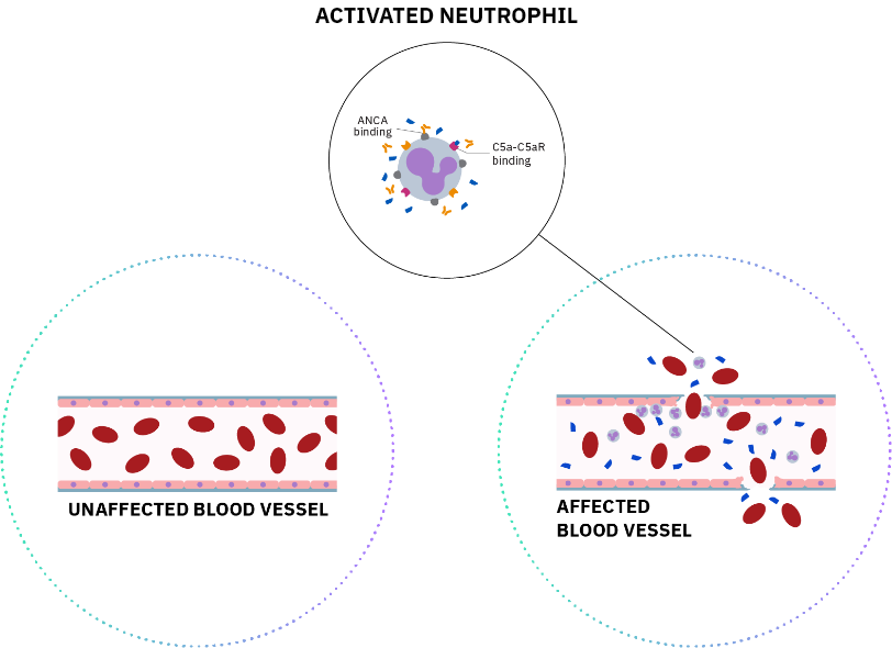 Severe active GPA and MPA characterized by neutrophil-induced inflammation and scarring of small-to-medium vessel endothelia