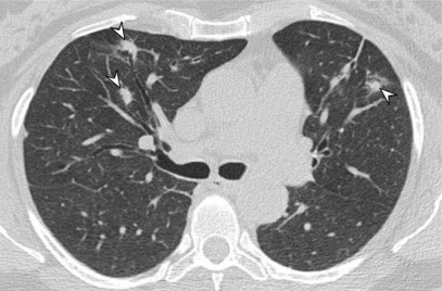 Example of chest CT scan