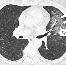 Chest computer tomography (CT) with ground-glass opacities