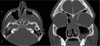 Example of CT scan of left front and left sphenoid sinus