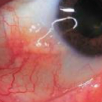 ANCA-associated vasculitis with scleritis