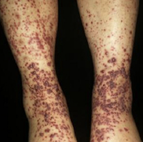 Bilateral lower extremity purpura