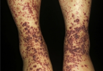 Bilateral lower extremity purpura