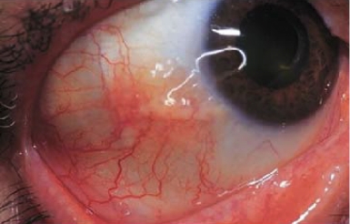 Example of eye exam with scleritis